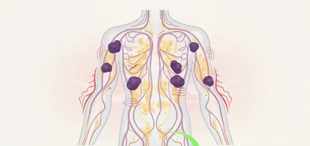 Animated diagram showing lymphatic flow throughout the body